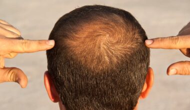 GLP-1 Drugs Could Nudge Some Men Toward Hair Loss, Study Suggests : ScienceAlert