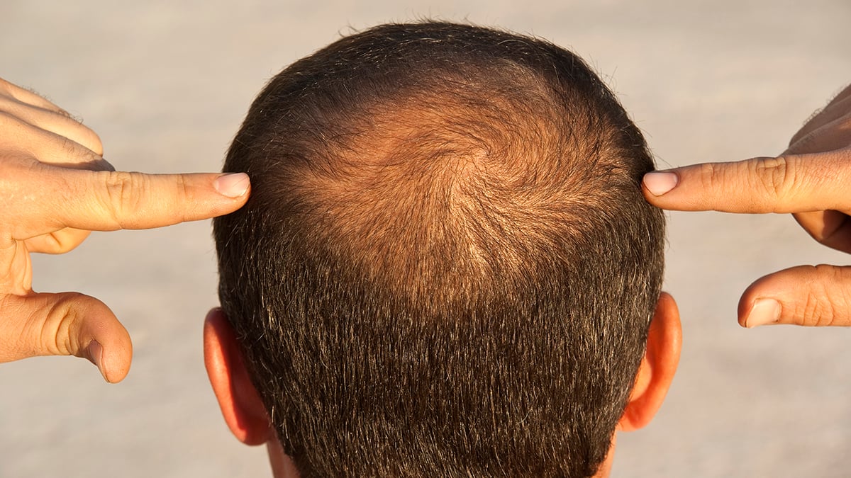GLP-1 Drugs Could Nudge Some Men Toward Hair Loss, Study Suggests : ScienceAlert