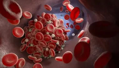 blood clot