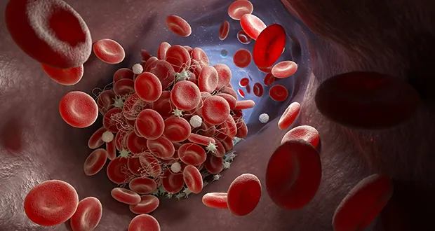 blood clot