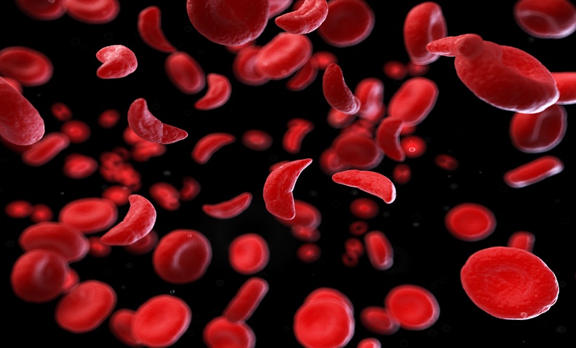 sickle cell