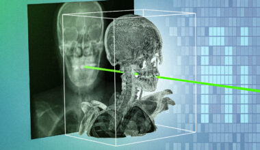 New AI technique could make minimally invasive surgeries safer and more precise | MIT News