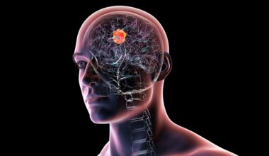 Brain cancer gliomarepresentation