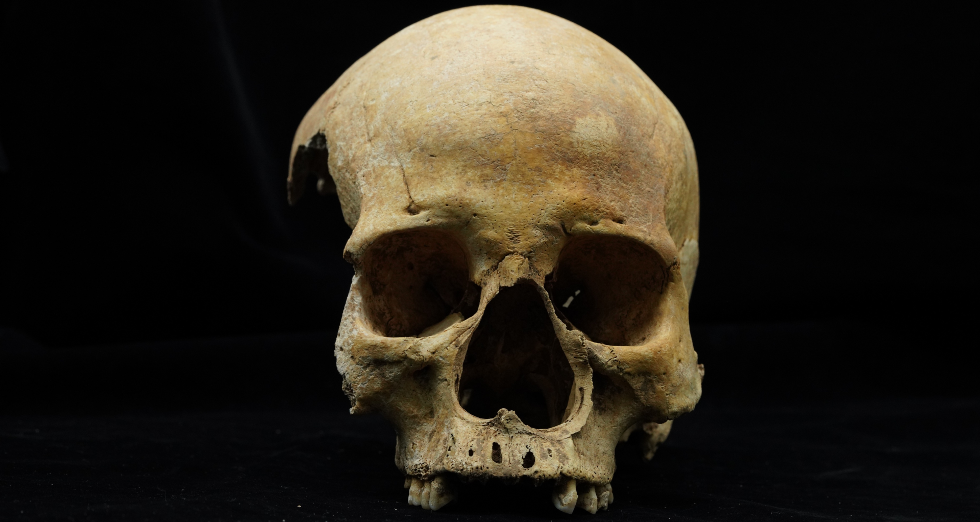 a front-facing human skull minus the mandible against a black background, revealing a curiously wide nasal opening