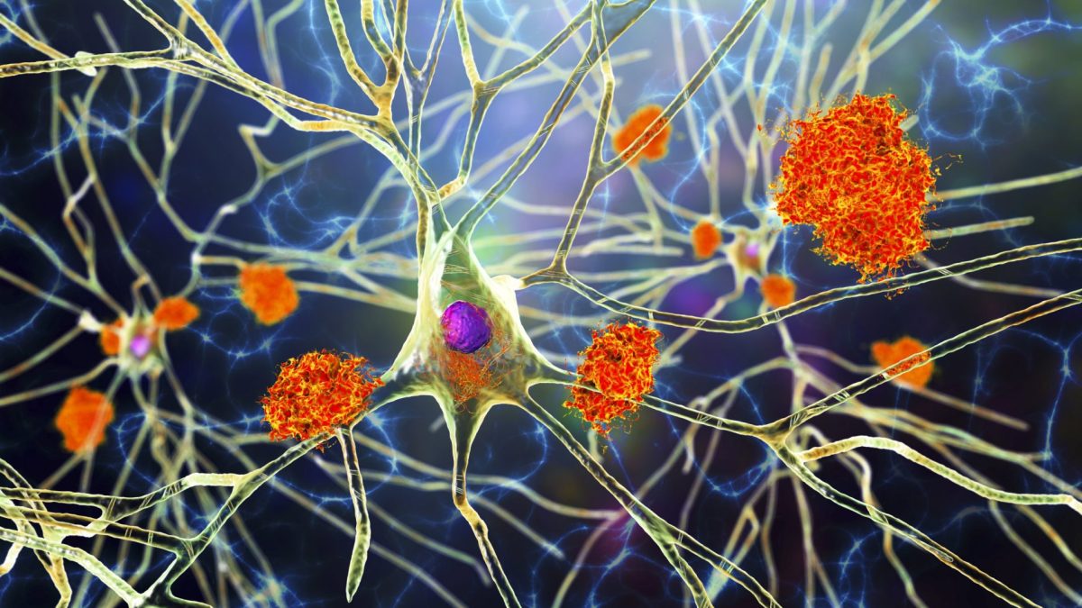 The drugs that could slow Alzheimer's