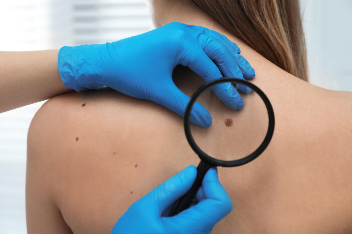 A medical professional examines a mole on a patient's back with a magnifying glass, revealing serious issues that started innocent.