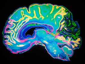MAVERICK Trial Supports Brain MRI Surveillance Alone as Standard of Care for SCLC