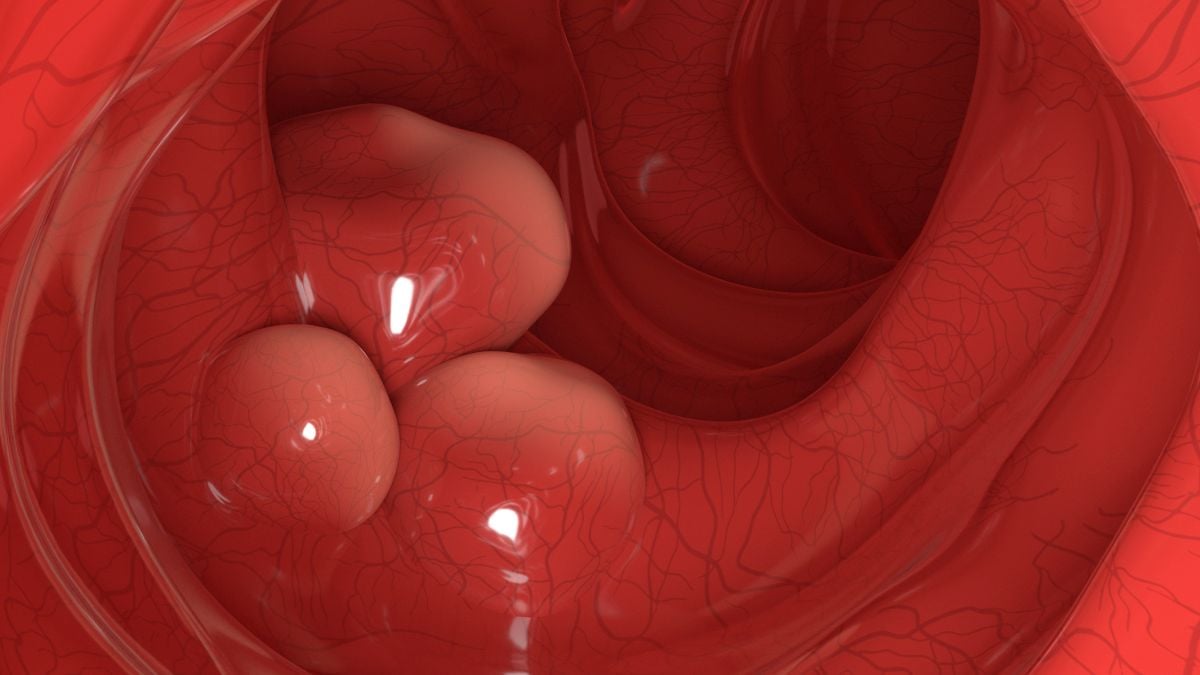 Engineered Probiotic Wipes Out 43% of Colorectal Tumors in Mice : ScienceAlert