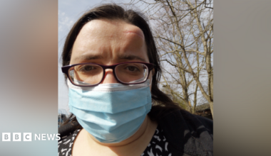 A woman wearing glasses and blue face mask with a large lump on her forehead.