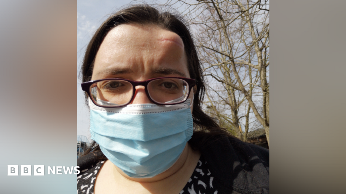 A woman wearing glasses and blue face mask with a large lump on her forehead.