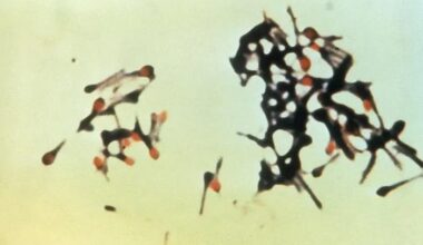 Czech Republic: 1st tetanus case in 4 years reported in Northern Moravia
