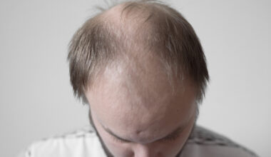Study Uncovers First Genetic Link Between GLP-1RA Use and Male-Pattern Hair Loss