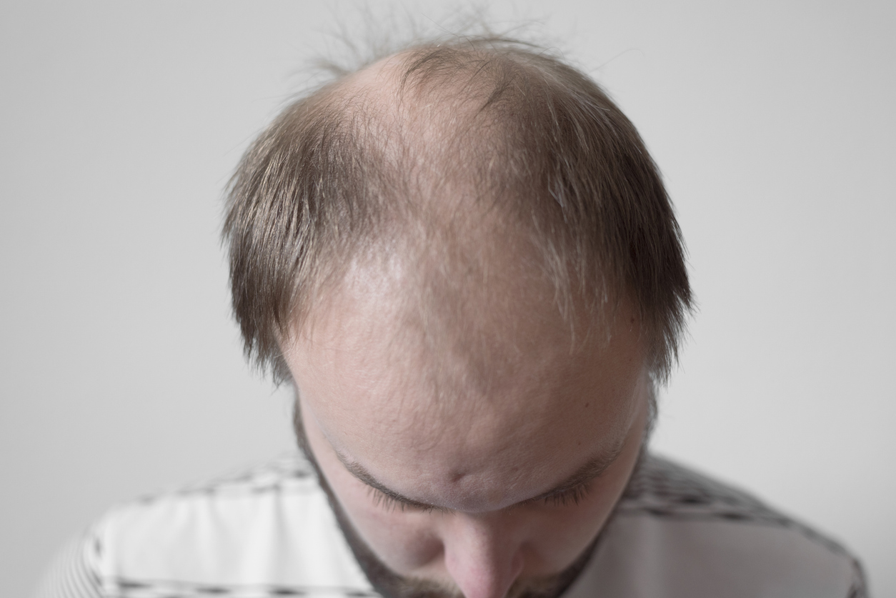 Study Uncovers First Genetic Link Between GLP-1RA Use and Male-Pattern Hair Loss