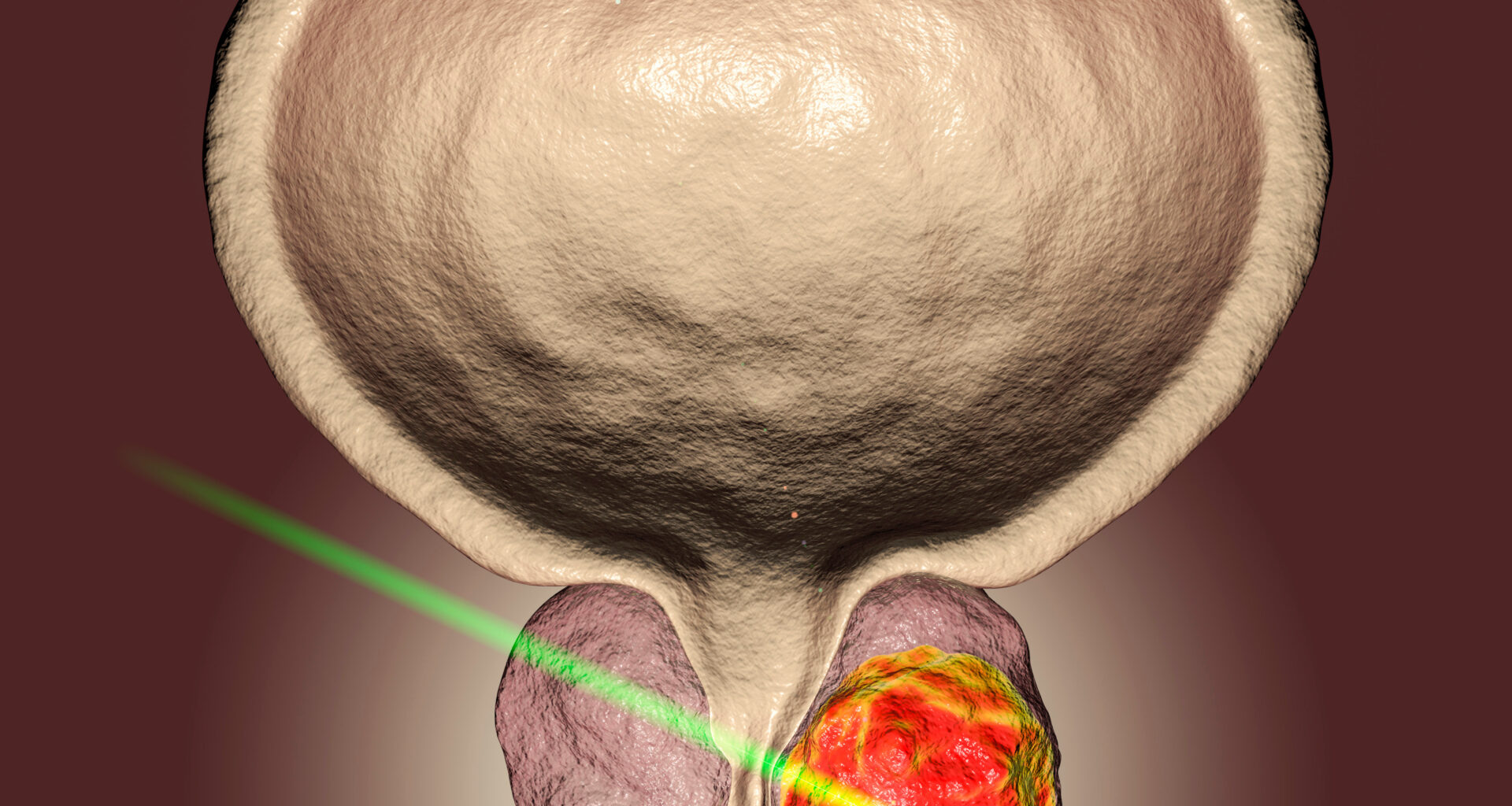 High-Risk Prostate Cancer GETUG-AFU 18 Suggests a Role for Dose-Escalated Radiotherapy With Long-Term ADT