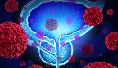 DAROL Examines Darolutamide With Lipid-Modifying Agents in Nonmetastatic Castration-Resistant Prostate Cancer