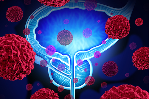 DAROL Examines Darolutamide With Lipid-Modifying Agents in Nonmetastatic Castration-Resistant Prostate Cancer