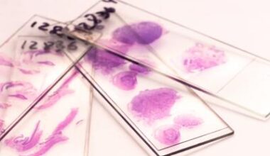AI scans pathology slides to predict pancreatic cancer recurrence • healthcare-in-europe.com