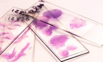 AI scans pathology slides to predict pancreatic cancer recurrence • healthcare-in-europe.com