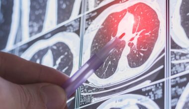 Pulmonary fibrosis is becoming more treatable