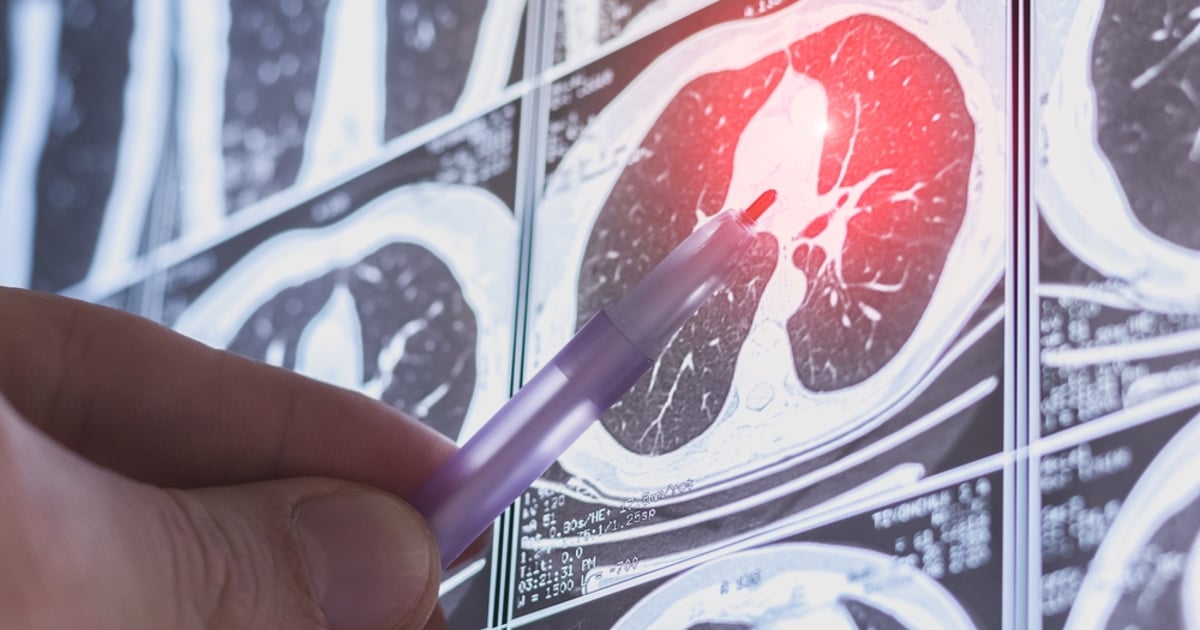 Pulmonary fibrosis is becoming more treatable