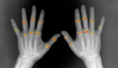 Some joints may be primed for rheumatoid arthritis before birth