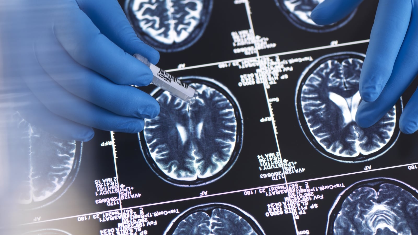 Call for HSE to allow access to Alzheimer's drug