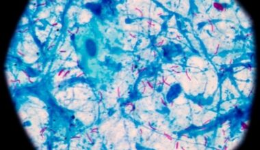 CRISPR-based tongue swab test shows promise for tuberculosis detection