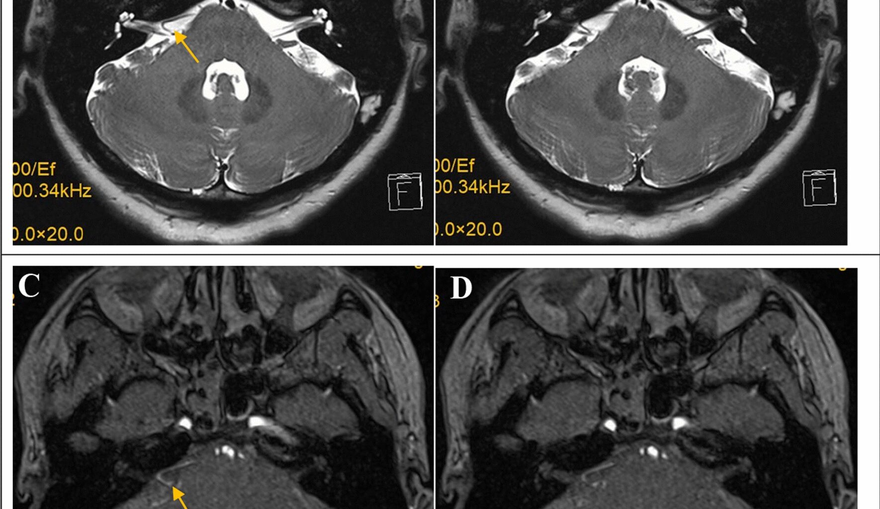 Hemifacial spasms caused by compression of the labyrinthine artery on the facial nerve in the internal auditory canal: a case report and review of the literature | Journal of Medical Case Reports