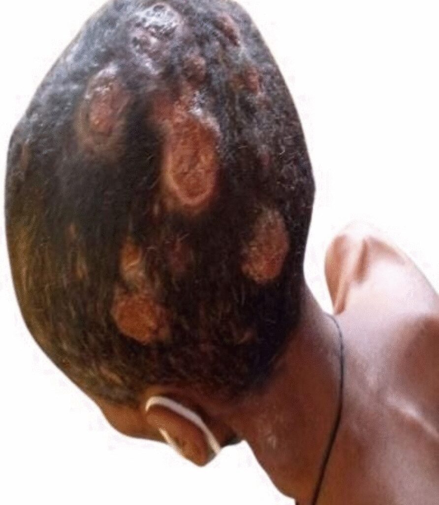 Case of cutaneous metastasis from presumed poorly differentiated thyroid carcinoma: a case report | Journal of Medical Case Reports