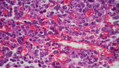 Using advanced computational methods, the researchers discovered 95 genes significantly associated with survival in cancers such as breast, ovarian, skin, and gastrointestinal cancers. Pictured: lung tissue adenocarcinoma as seen under a microscope. Photo/iStock.