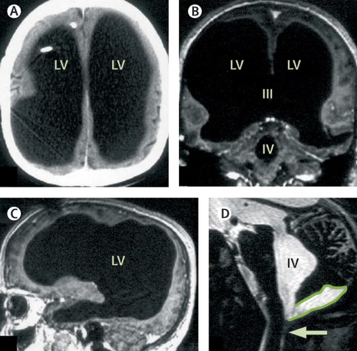 Brain scans from a 2007 study in The Lancet that looked at the French man's brain. (Pic courtesy: The Lancet)