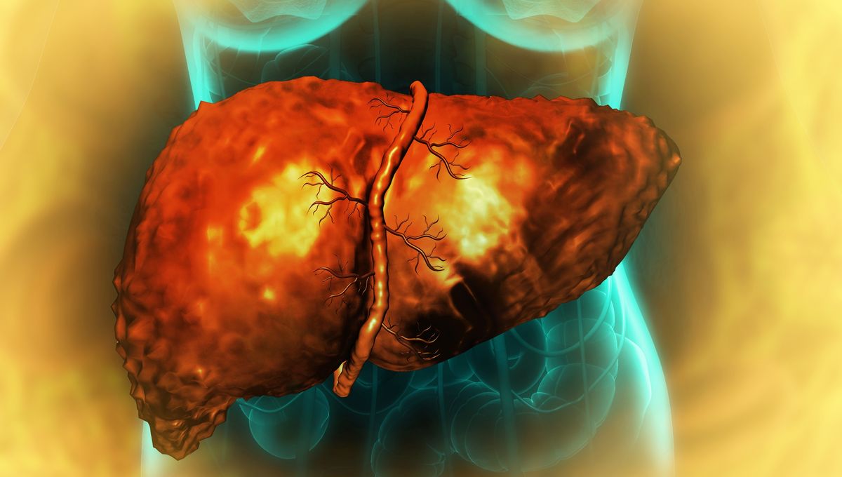 A Henna Plant Extract Could Be A Surprisingly Effective Treatment For Liver Fibrosis