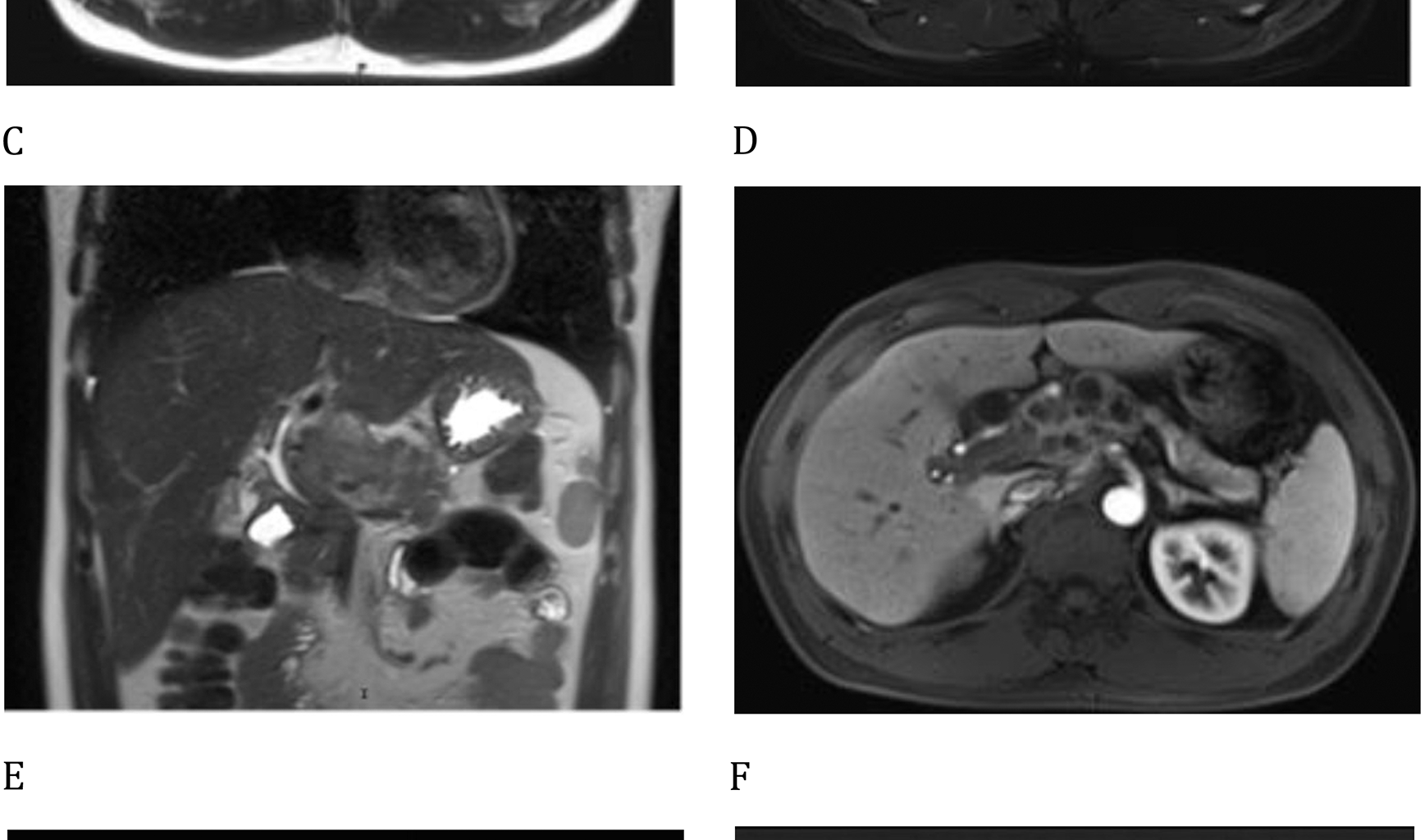 A case report of pancreatic tuberculosis: arterial infusion of isoniazid as an adjunct to oral antituberculosis medications has demonstrated promising therapeutic efficacy | BMC Infectious Diseases