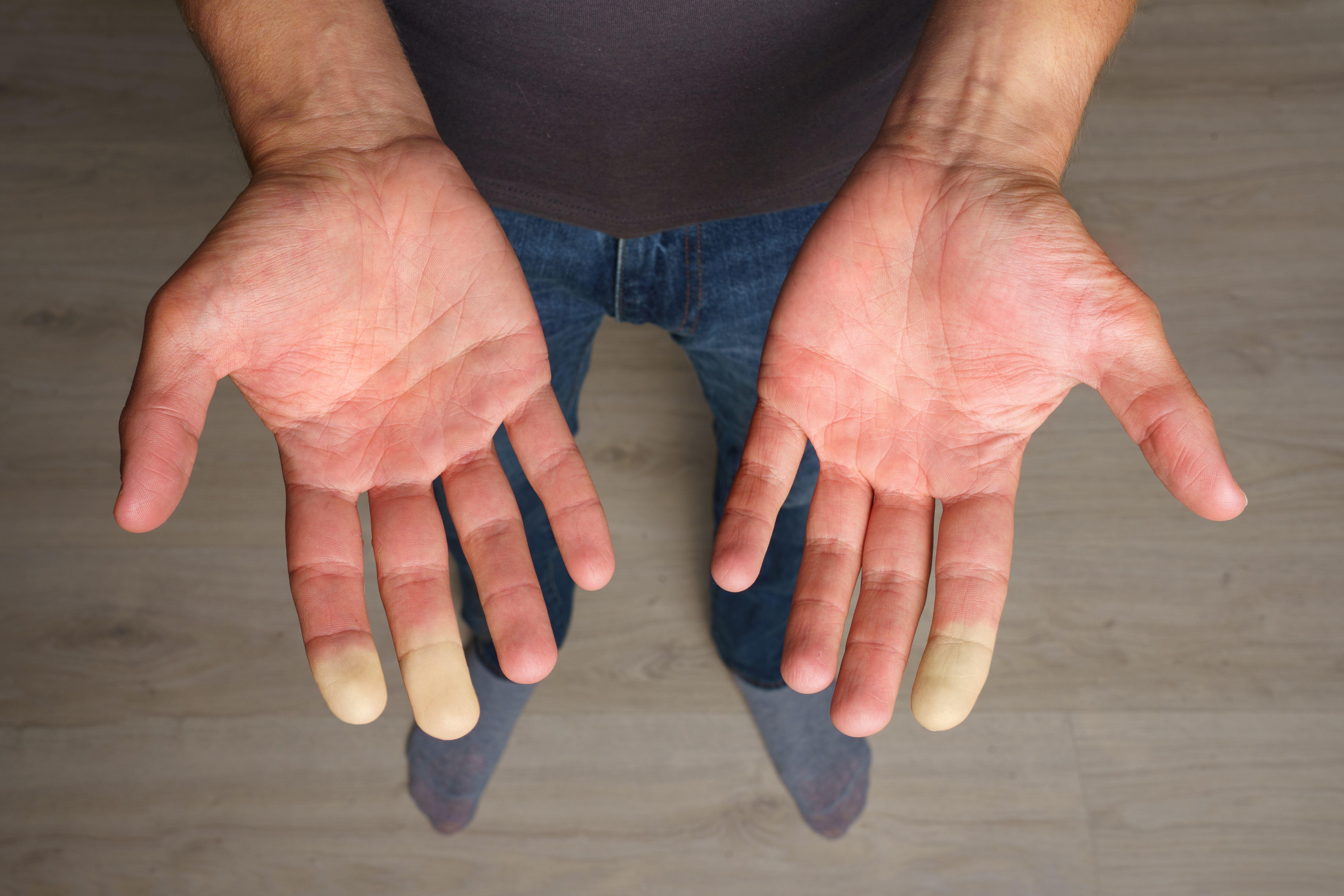 A man with Raynaud’s showing his hands