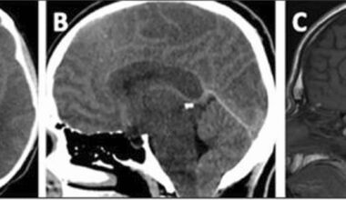 Cerebral edema in maple syrup urine disease: spectrum of clinical presentation and treatment outcomes | Orphanet Journal of Rare Diseases