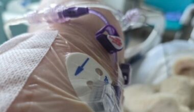 Canadian seniors struggle to recover post-surgery: study