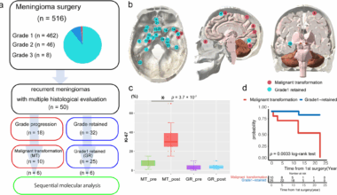 Sequential omics analysis reveals molecular signatures of malignant transformation in recurrent meningiomas | Acta Neuropathologica Communications