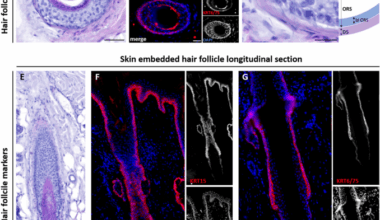 Ex vivo detection of SARS CoV 2 spike protein in human hair follicles and potential link to telogen effluvium