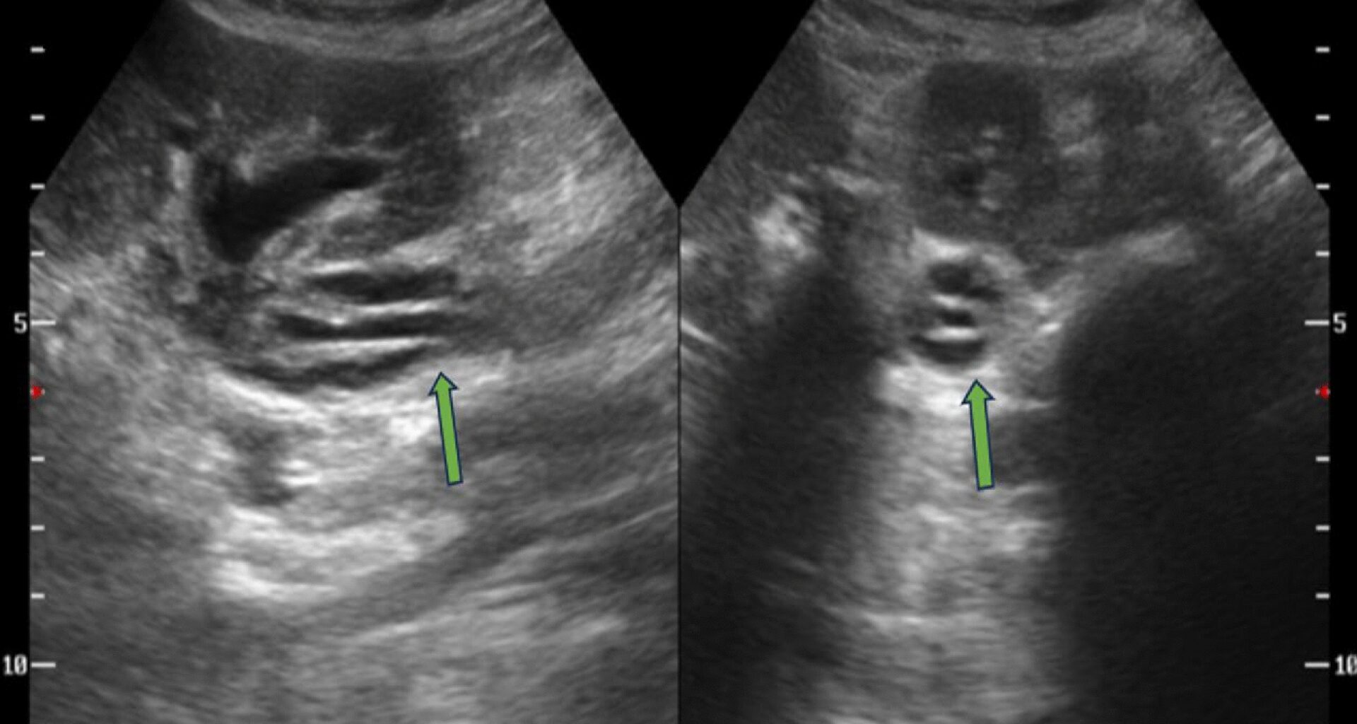 A rare curious case of ureteric dissection in a patient with vaginal vault recurrence of endometrial carcinoma | Egyptian Journal of Radiology and Nuclear Medicine