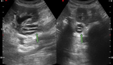 A rare curious case of ureteric dissection in a patient with vaginal vault recurrence of endometrial carcinoma | Egyptian Journal of Radiology and Nuclear Medicine