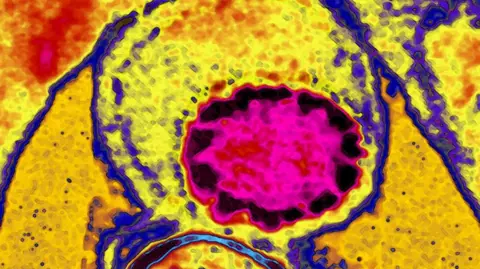 Getty Images A CAT scan image made up of vibrant abstract shapes and colours. At the heart of the image is a large, circular shape that glows with a deep, electric pink. It’s surrounded by a dark, almost black border, giving it the appearance of a nucleus or a central core. Radiating outward from the centre are patches of fiery red and golden yellow. Thin purple and bright blue lines trace the edges of some regions, resembling membranes or boundaries.
