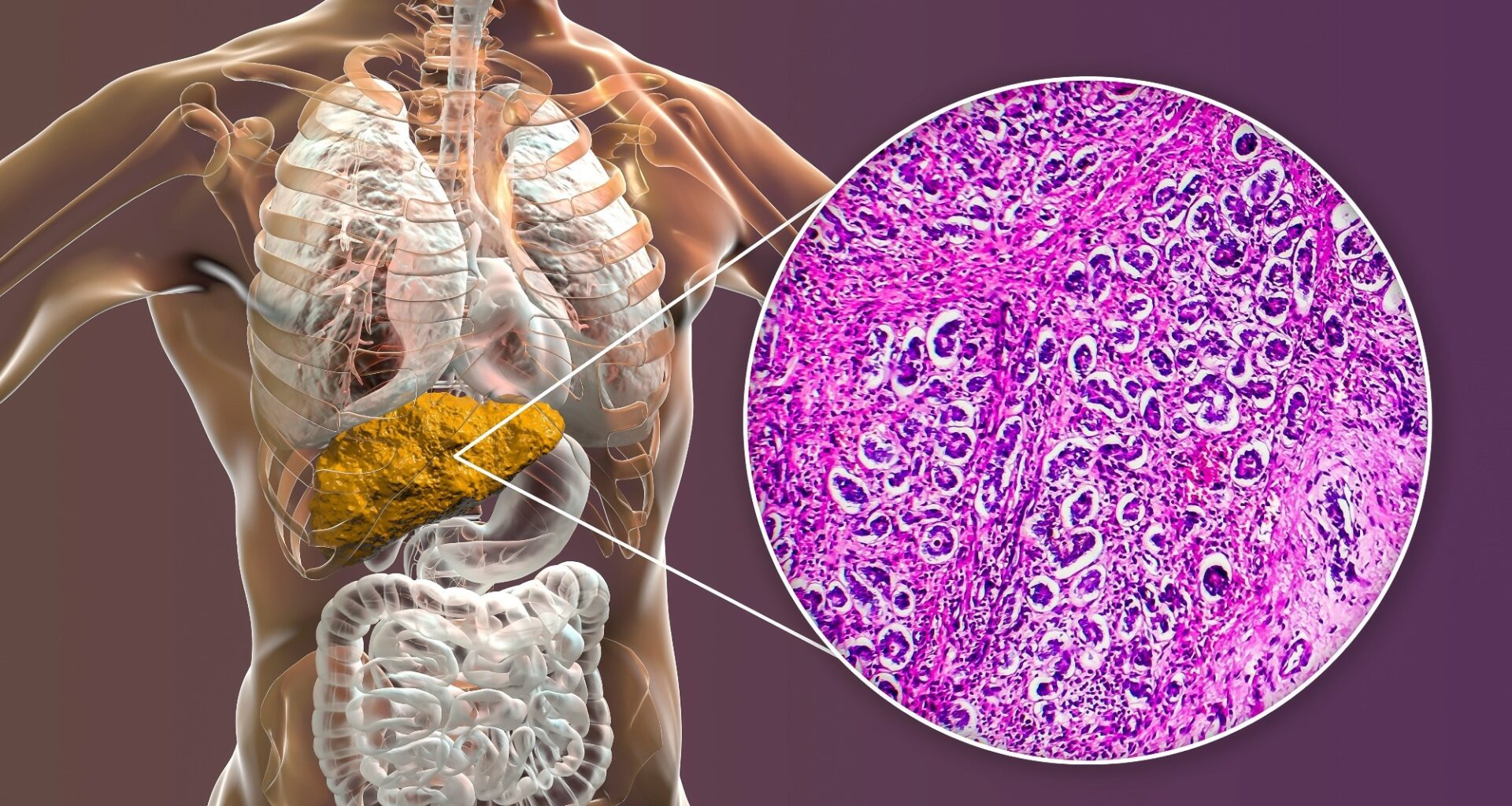 Liver with cirrhosis inside human body. 3D illustration and light micrograph of biliary cirrhosis