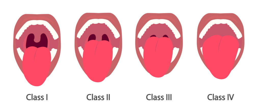 Mallampati Score. Assessment to predict the difficulty of airway management during intubation.