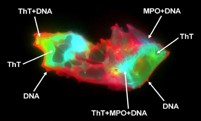 A long COVID patient's microclot. The green areas are abnormal sticky proteins, while the red and blue parts are cellular material. (<a href="https://www.eurekalert.org/multimedia/1100665" rel="nofollow noopener" target="_blank" data-ylk="slk:Dr Chantelle Venter;elm:context_link;itc:0;sec:content-canvas" class="link ">Dr Chantelle Venter</a>)