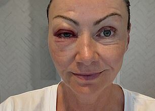 Nicky Buckley has shared a confronting glimpse into her recovery after undergoing eye surgery