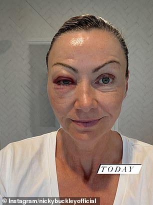 Nicky Buckley has shared a confronting glimpse into her recovery after undergoing eye surgery