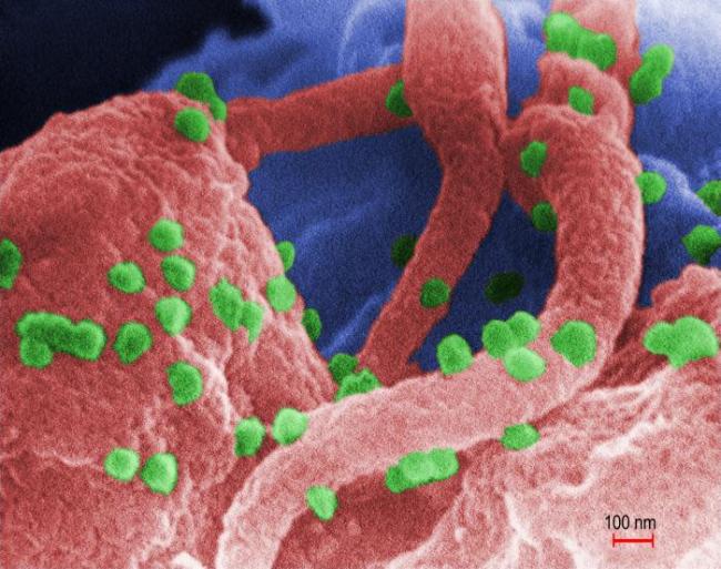 Scanning electron micrograph shows HIV as tiny green spheres scattered atop the surface of a lymphocyte cell.