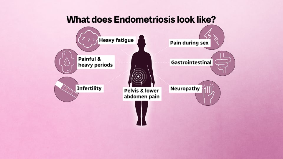 A graphic showing the symptoms of endometriosis