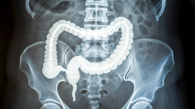 Why a stiffer colon is raising alarms as colorectal cancer appears earlier: How to identify it