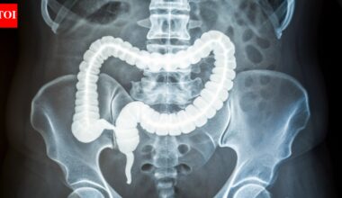 Colorectal Cancer: Why a stiffer colon is raising alarms as colorectal cancer appears earlier: How to identify it |